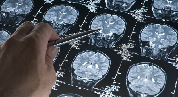 Tumore al cervello, finalmente è stato scoperto come bloccarlo