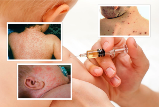 Morbillo, in Salento è allarme: 40 casi in un mese. “Serve la vaccinazione”