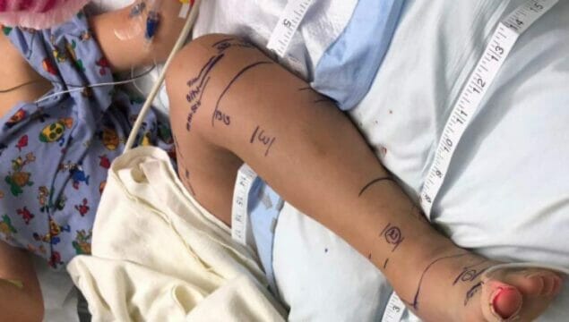 Bimba di 7 anni morsa due volte da una vipera: è gravissima