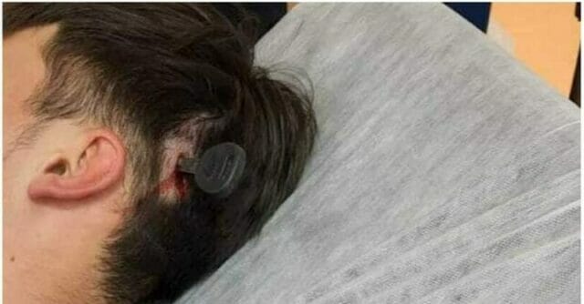 Rissa al campo di calcio, 12enne in ospedale con una chiave infilzata in testa
