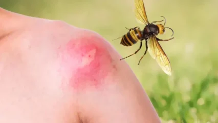 Puntura di vespa sul braccio