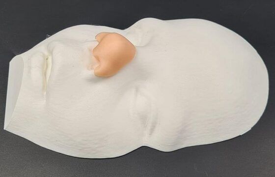 Bambino nasce senza naso e gli viene ricostruito in 3D: “Ora sono come gli altri”