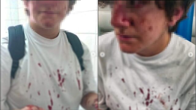 16enne aggredito davanti alla scuola: naso fratturato e lesioni agli occhi