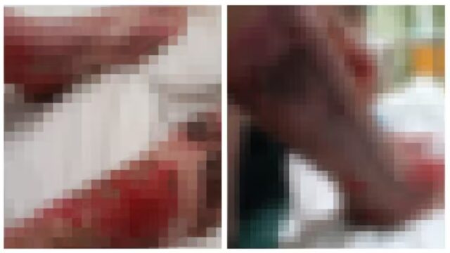 Bambino di 10 anni gravemente ustionato per un’auto parcheggiata che ha preso fuoco: choc in città